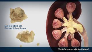 Percutaneous Nephrolithotomy PCNL [upl. by Modeerf406]