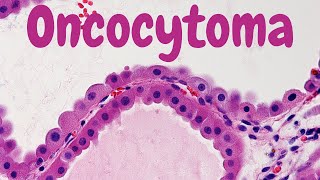 Renal Oncocytoma  Pathology mini tutorial [upl. by Creight]