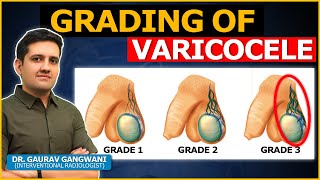 What are the Grades or Stages of Varicocele  Dr Gaurav Gangwani Interventional Radiologist [upl. by Cimbura766]