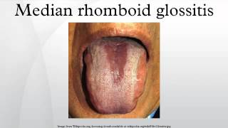 Median rhomboid glossitis [upl. by Swithin]