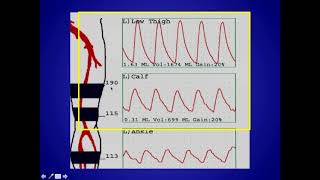 How to Perform and Interpret Peripheral Arterial Doppler Examinations [upl. by Sutit783]