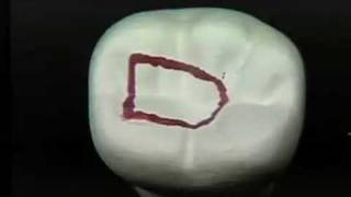 Endodontic Cavity Preparation  Phase I  Posterior [upl. by Nosnaj601]