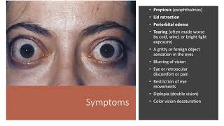 Thyroid Eye Disease [upl. by Larret]