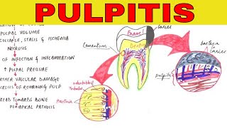 Pulpitis  Pathophysiology Causes amp Types [upl. by Asiulana]