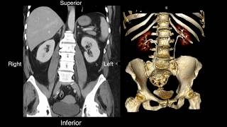 Normal Renal Anatomy [upl. by Etnud]