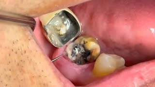 4 Wisdom Teeth Removal Surgery [upl. by Cordova]