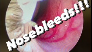 Nosebleeds epistaxis causes prevention treatments and more [upl. by Togram]