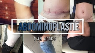 ABDOMINOPLASTIE 1 AN APRES [upl. by Enriqueta]