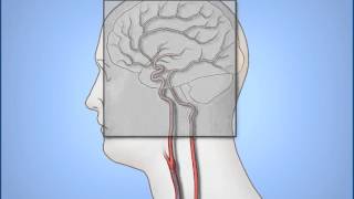 Coronary Angiogram RAO cranial view [upl. by Flossi527]