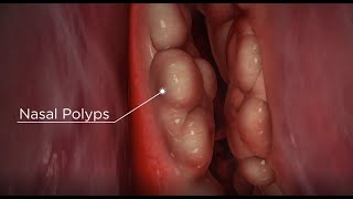 How to Give Yourself a Dupixent Injection [upl. by Staford]