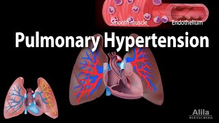 Pulmonary Hypertension Animation [upl. by Ethelstan503]