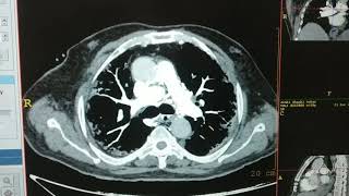 CT PULMONARY ANGIOGRAPHY [upl. by Stedman]