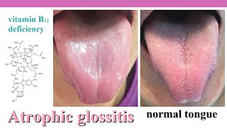 atrophic glossitis [upl. by Inat]