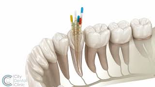 Endodontics  Root canal treatment  City Dental Clinic Bratislava [upl. by Analat]