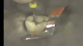 Cleaning and Shaping Root Canal  Curved Canal [upl. by Anawd]