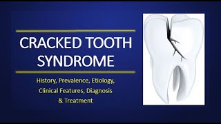 Cracked Tooth Syndrome Symptoms Diagnosis amp Treatment [upl. by Allak883]