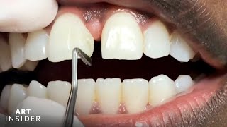 How Should a Proper Bite Fit Together Orthodontist Buffalo NY [upl. by Nanaek]