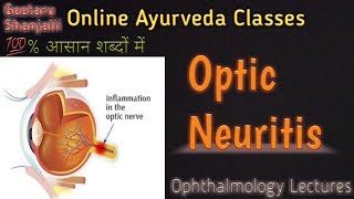 Optic Neuritis by Geetaru [upl. by Maggs]