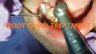 ROOT CANAL TREATMENT [upl. by Ezalb]