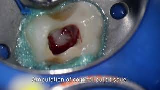 MTA pulpotomy – Video abstract ID 134315 [upl. by Nagar532]