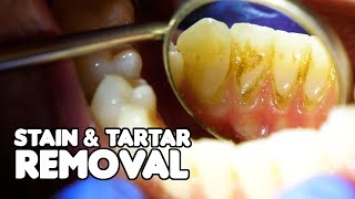 Dental Cleaning EXPLAINED  Stain amp Tartar Removal [upl. by Tiloine882]