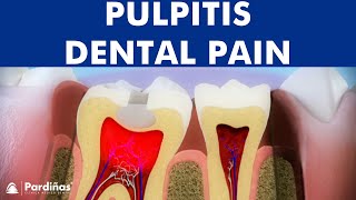 Pulpitis  Inflammation of tooth pulp © [upl. by Acnaiv]