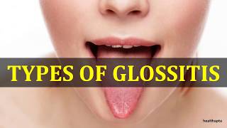 GLOSSITIS [upl. by Tserrof]