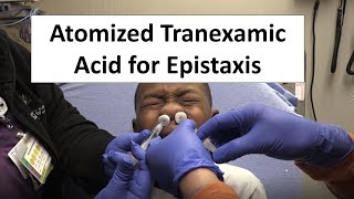 Atomized Tranexamic Acid for Epistaxis Control [upl. by Nylyahs140]