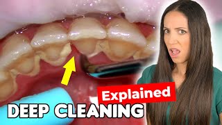 Dental Hygienist Explains Deep Cleaning Procedure [upl. by Medora697]