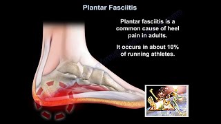 Plantar Fasciitis  Everything You Need To Know  Dr Nabil Ebraheim [upl. by Ardekal]