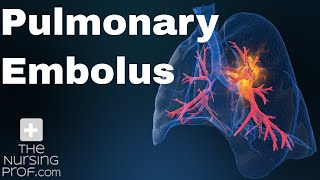 Pulmonary Embolus Nursing Care [upl. by Aicekat]