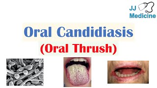 Oral Candidiasis Oral Thrush  Causes Pathophysiology Signs amp Symptoms Diagnosis Treatment [upl. by Valer]