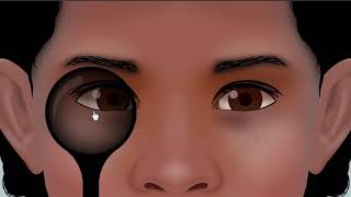 examination of esotropia  animation [upl. by Budwig]