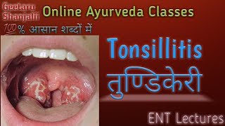 Tonsillitis or तुण्डिकेरी [upl. by Malik]