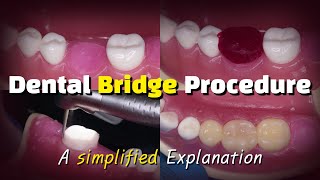 Dental Bridge Procedure [upl. by Bricker]