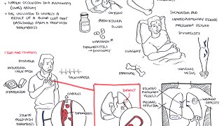 Pulmonary Embolism  Overview [upl. by Polad]